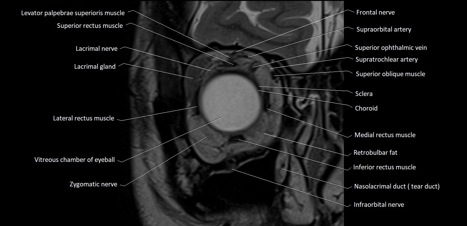 MRI Orbit coronal cross sectional anatomy image 6.webp